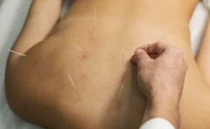 Acupuncture needles inserted into a person's back, with a hand adjusting one of the needles.